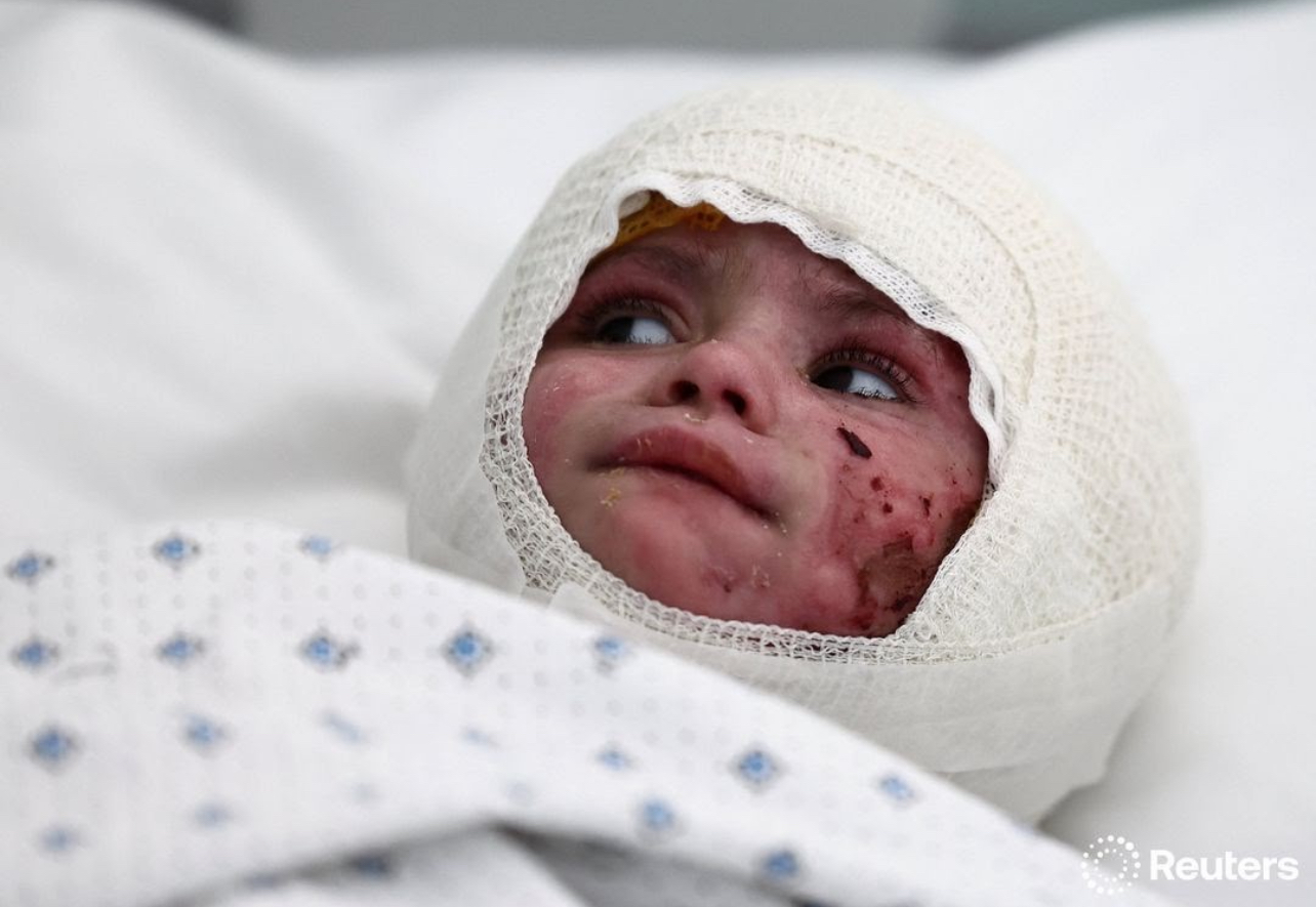 Lebanon/ Toddler Lies Motionless in a Hospital Bed Following Israeli airstrikes